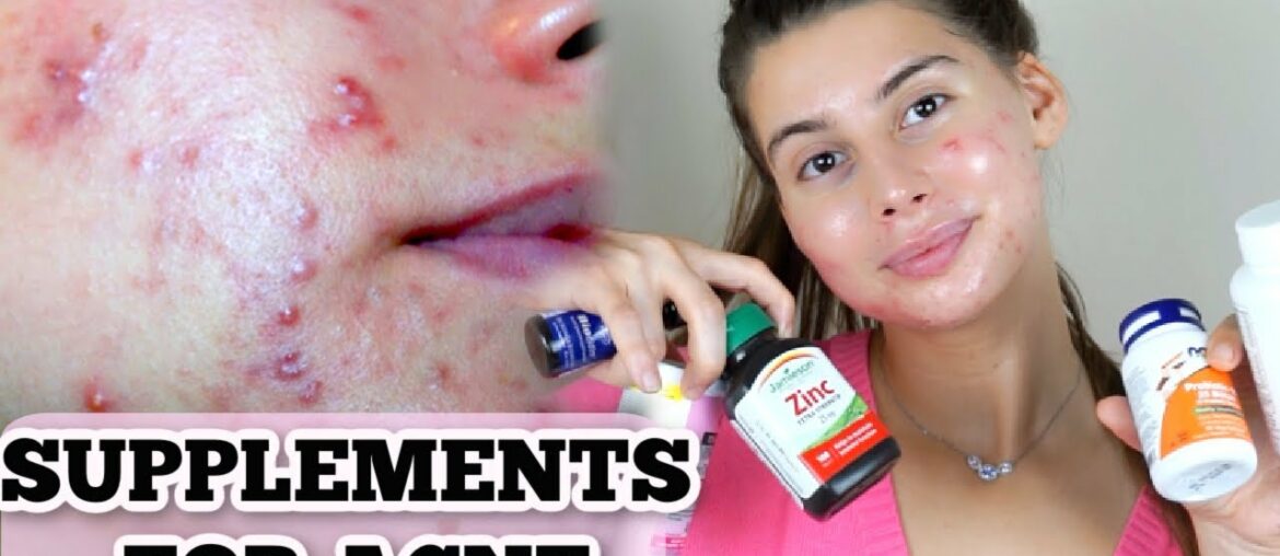 SUPPLEMENT UPDATE FOR MY ACNE|| ALL OF THE SUPPLEMENTS I TAKE FOR CLEAR SKIN!!