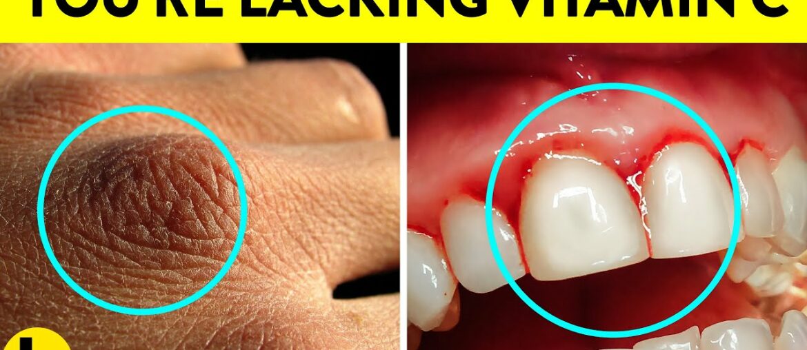 Signs Your Body Is Lacking Vitamin C & Its Benefits