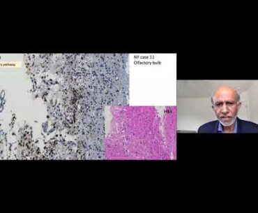 Science of COVID-19: "Neurological Complications of Coronaviruses"