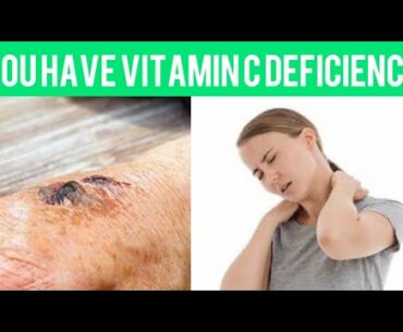 15 SIGNS AND SYMPTOMS OF VITAMIN C DEFICIENCY