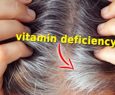 The Lack Of This Vitamin May Be Causing Your Hair Loss and Gray Hair