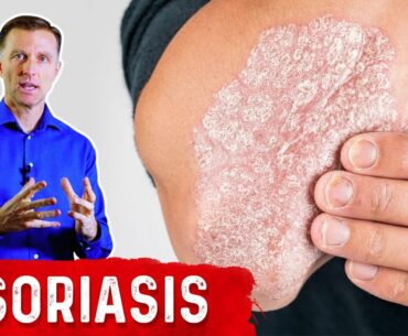 The Best 3 Remedies for Psoriasis