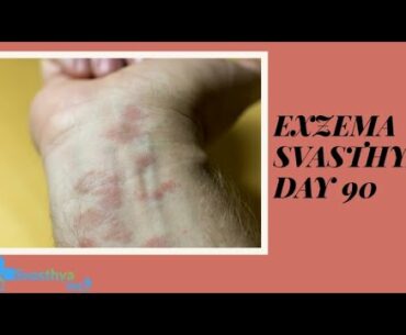 Eczema I Day- 90