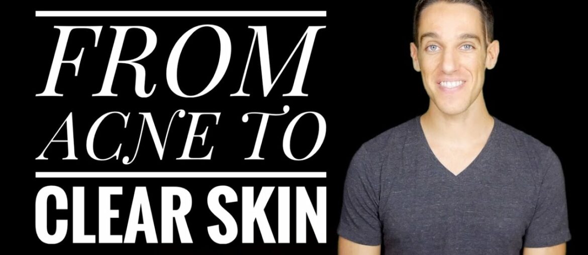 Natural Acne Remedies - The Best Herbs and Supplements for Clear Skin