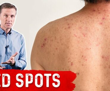 Why Red Spots on My Skin?