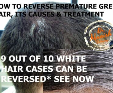 Reverse White Hair/Premature greying with Homeopathy | Causes,Diet,Vitamins in Poliosis@ Childhood