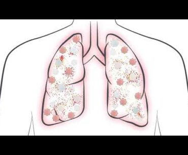What is a Cytokine Storm and How Does it Impact COVID-19 Patients?