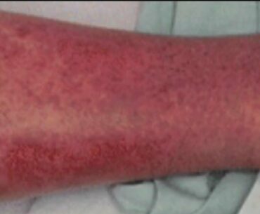 Why Does Coronavirus Cause Harmful Rashes?