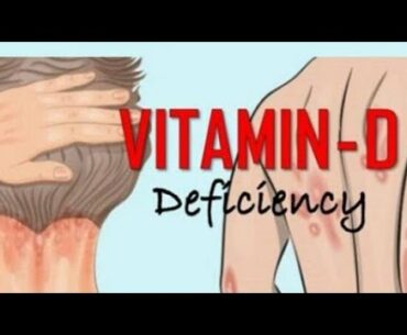 Vitamin D Deficiency l Symptoms of Vitamin D l Vitamin D Deficiency Symptoms (Hindi)