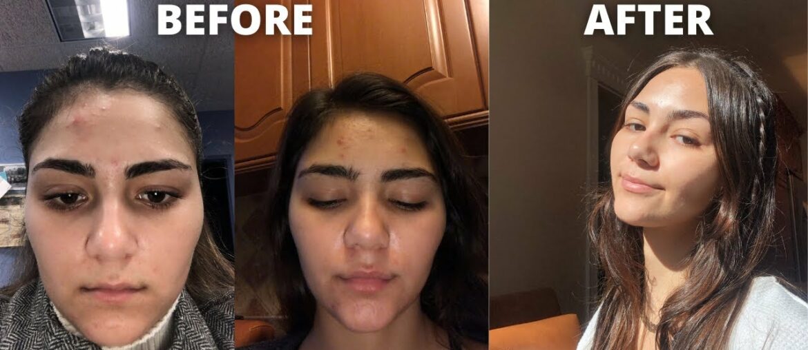 BREAKING OUT NIGHTTIME SKINCARE ROUTINE: Curology, Aztec Healing Clay Mask, The Ordinary & more