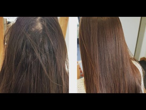 Amplixin Advanced+ Biotin Supplement - Hair Vitamins For Faster Hair Growth, Stronger Nails & C...