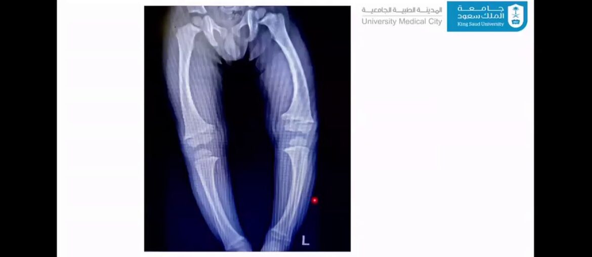 Pediatric Grand Round: Rickets: Beyond Vitamin D Deficiency