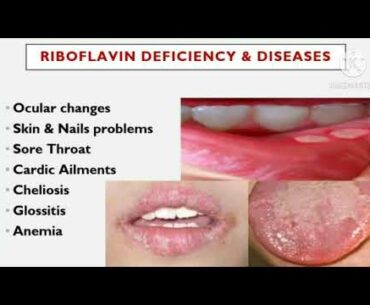 Importance of Vitamins for body, types of vitamins & deficiency diseases