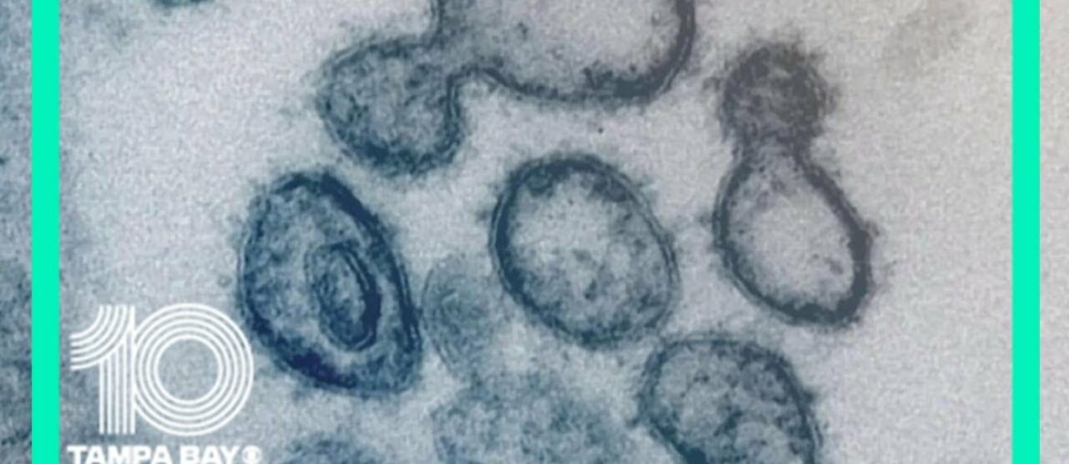 Concern grows over relaxing COVID-19 restrictions after research shows man caught virus twice