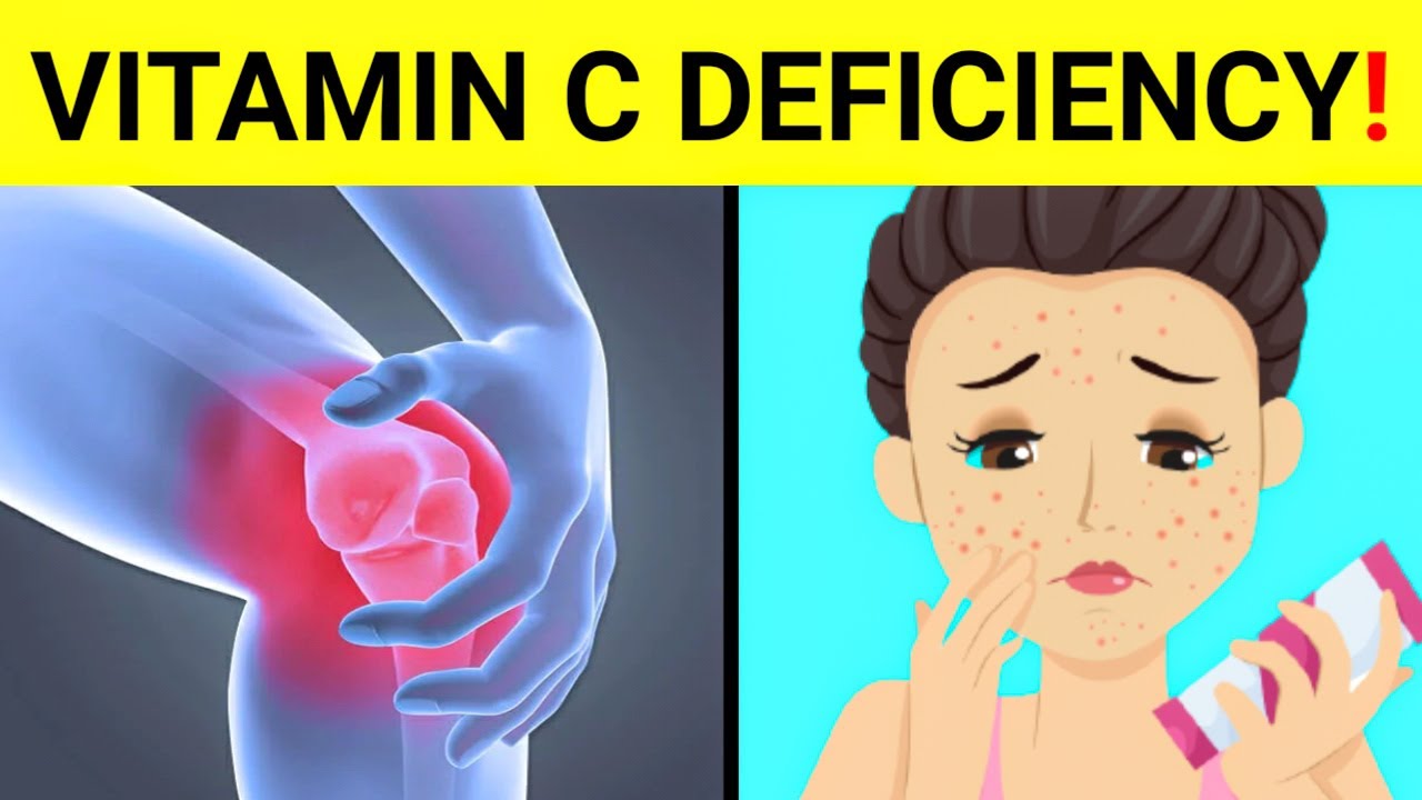 15 Signs And Symptoms Of Vitamin C Deficiency ( Vitamin C Deficiency