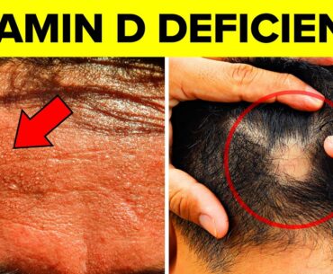 8 Signs Your Body Is Desperate For Vitamin D