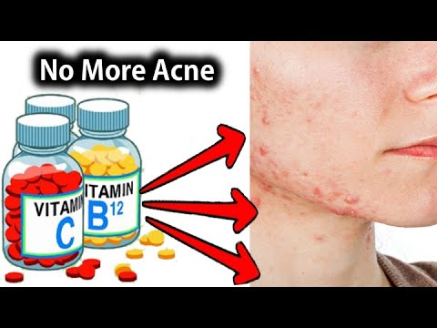 Best Minerals and Vitamins for Acne Treatment