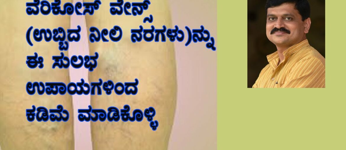 VARICOSE VEINS | DR VENKATRAMANA HEGDE | VEDA WELLNESS CENTER | NISARGAMANE | SIRSI