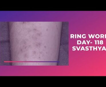 Ringworm Part 1 I Day-118