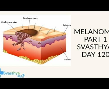 Melanoma part 1 I Day-120