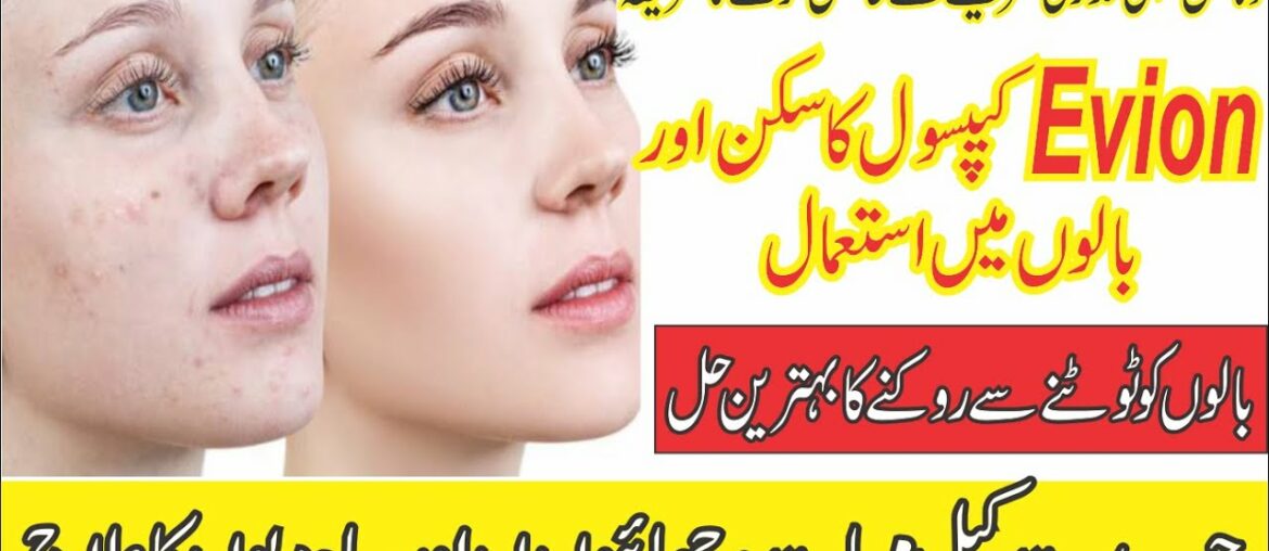 Evion Capsules Uses For Skin & Hair Part 2 I Natural Reasources of Vitamin-E I Side Effects of Evion