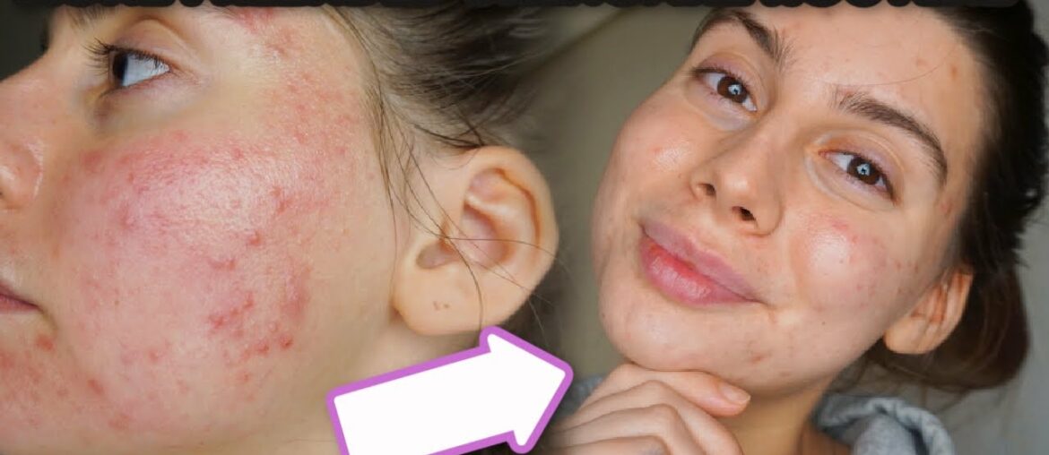 MY ACNE SKINCARE ROUTINE || EVENING ROUTINE, SIMPLE Skincare