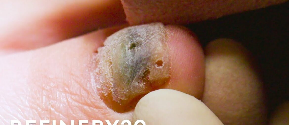 Why I Go To A Doctor For A Pedicure | Macro Beauty | Refinery29