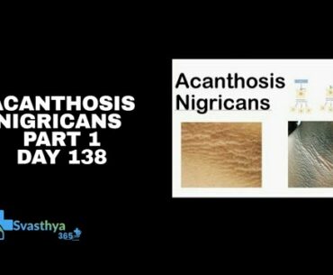 Acanthosis Nigricans I Day 138