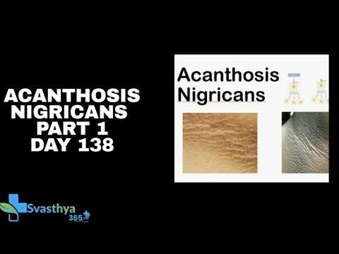 Acanthosis Nigricans I Day 138