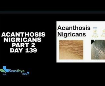 Acanthosis Nigricans Part 2 I Day 139
