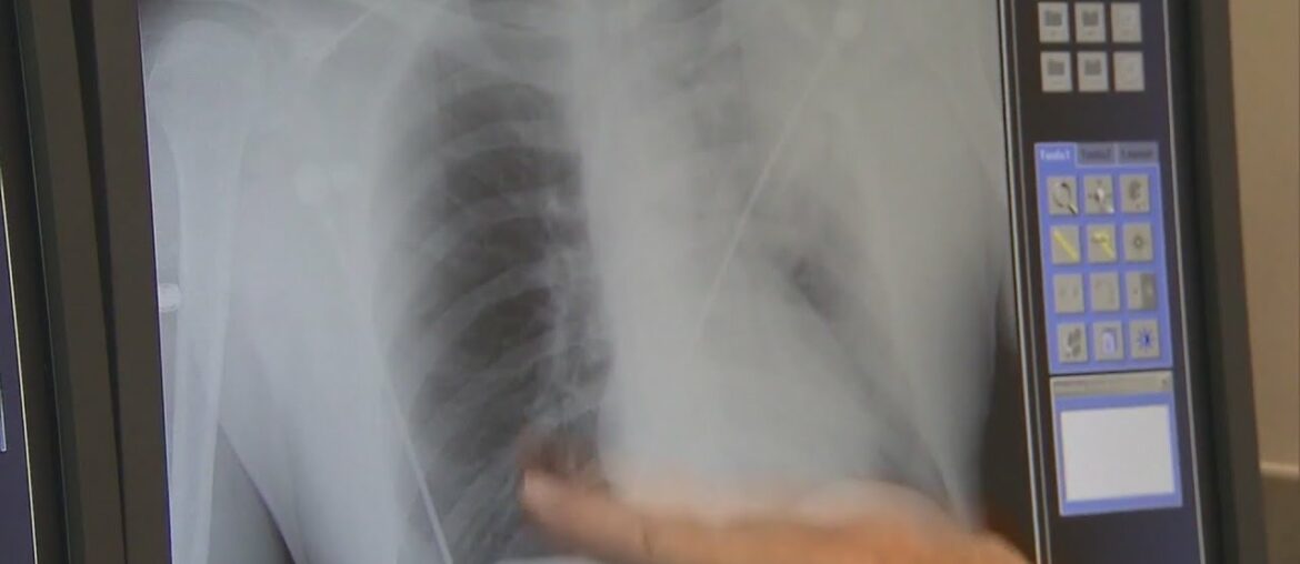 Washington Univ. clinical study aims to stop the COVID cytokine storm