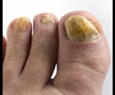 Toe Nail  Fungus De-termination