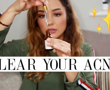 SKINKISSED VITAMIN C FACE SERUM REVIEW| ACNE PRONE SKIN