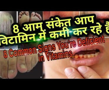 vitamin deficiency syndrome in Hindi