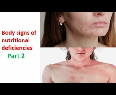 Body signs of nutritional deficiencies - Part 2