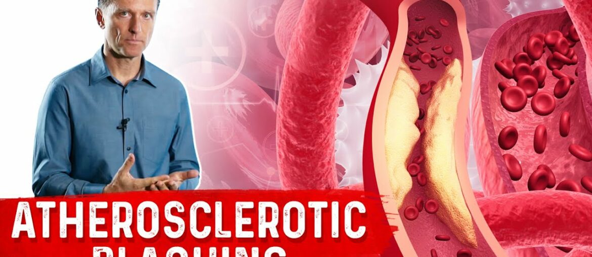 Protocol for Calcified Plaque in Your Arteries