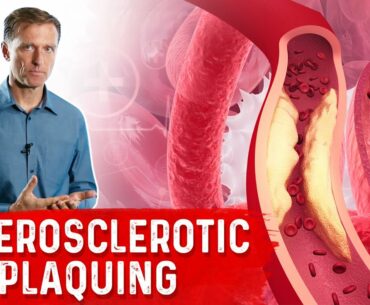 Protocol for Calcified Plaque in Your Arteries