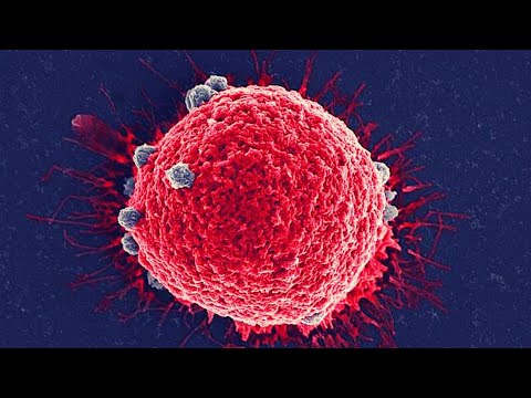 Vitamin D supplements may reduce the risk of developing advanced cancer