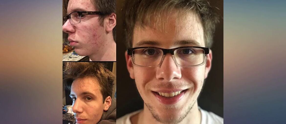 Clear Skin Advanced Vitamin Pack for Acne - 60 Day Supply of Vitamins for Acne review