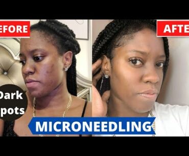 How To Get Rid Of Acne Scars|Hyperpigmentation| Microneedling With Glutathione and Vitamin C.