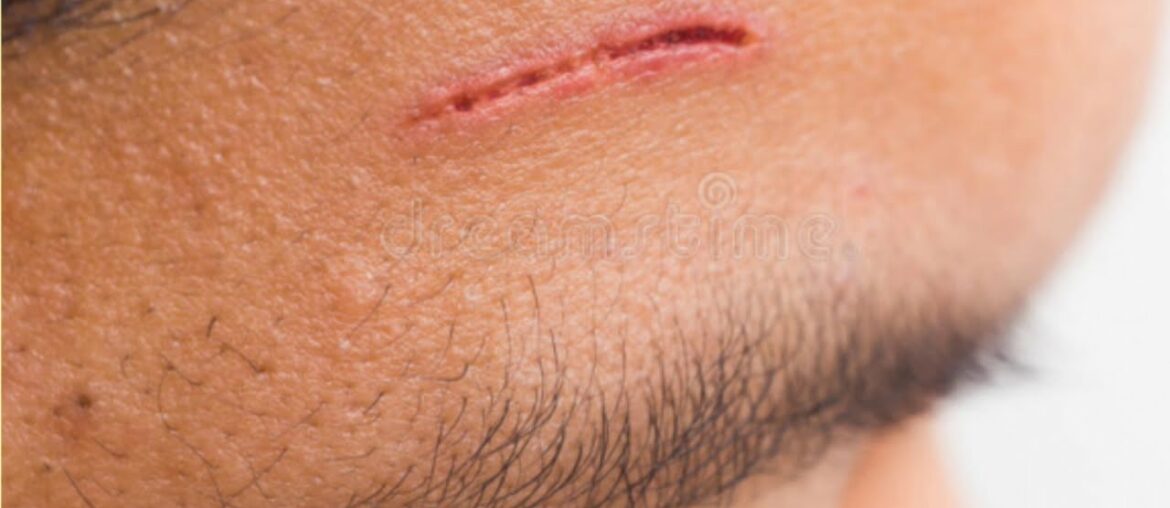 SIGNS OF VITAMIN D DEFICIENCY ( malayalam)