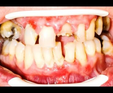 Vitamin Supplements For Healthy Teeth And Gums - Dose This G-Force Teeth Advanced Dental Health