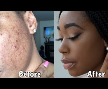 HOW I PREVENT HYPERPIGMENTATION WHILE WEARING MAKEUP|ChimereNicole