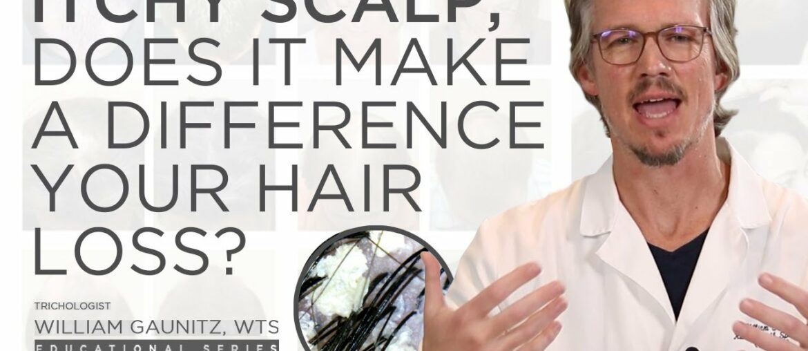 Does an Itchy Scalp have an impact on hair loss? Dandruff, Seborrheic Dermatitis, and Treatment