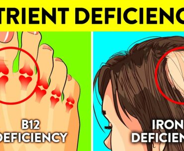 7 Incredibly Common Nutrient Deficiencies