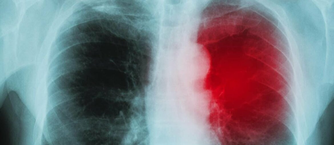 Study looks at COVID-19 impact on hearts of athletes