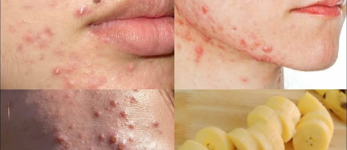 Banana face mask for pimples | get spotless,glowing skin | Beauty She Loves