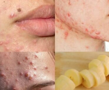 Banana face mask for pimples | get spotless,glowing skin | Beauty She Loves