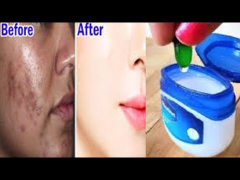 Top 5 Uses Of Vitamin E Oil For Skin - Remove Dark Spots, Get Rid of Acne  And Hyperpigmentation