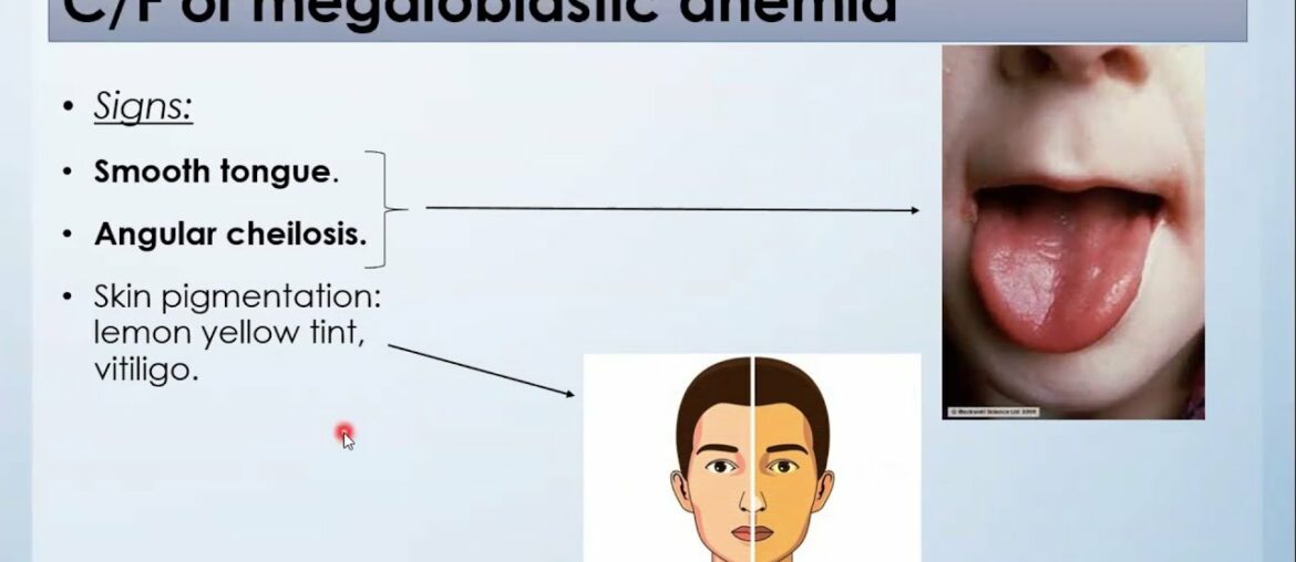 Megaloblastic Anaemia | Vitamin B12,Folate deficiency | Pernicious Anemia